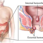 Le emorroidi: sintomi, cause,segni e terapie