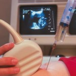 Amniocentesi: informazioni, motivi, preparazione e rischi