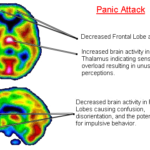Gli attacchi di panico: sintomi, cause, complicazioni e terapie