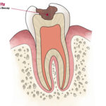La carie dentaria:primi segni, sintomi,prevenzione e rimedi