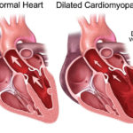 rp_inform-cardiomiopatia.jpg