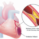 ischemia