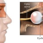 Neurite ottica : sintomi, segni, cause e cure