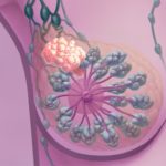 Carcinoma mammario infiammatorio : segni, sintomi, diagnosi e cure