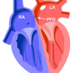 rp_forame-ovale-pervio1.gif