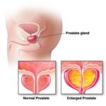 Allargamento della prostata : segni, sintomi, cause, cure e consigli