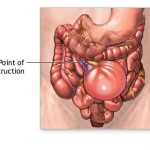 Ostruzione intestinale : sintomi, segni, cause, diagnosi e cure