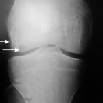 rp_osteocondrite-dissecante1.jpg