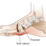 Malattia di Charcot Marie Tooth : sintomi, cause e cure