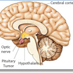 rp_acromegalia-1.jpg