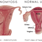Adenomiosi : sintomi, cause, diagnosi e cure