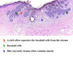 Carcinoma a cellule basali : sintomi, segni, cause e cure