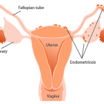 Endometriosi : sintomi, cause, diagnosi e cure