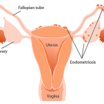 rp_endometriosi1.gif