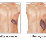 Ingrossamento della milza (splenomegalia) : sintomi, cause e cure