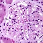Nefropatia membranosa : sintomi, cause, diagnosi e cure