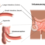 Intussuscezione : sintomi, cause, diagnosi e cure