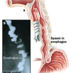 Spasmo esofageo : sintomi, cause e cure