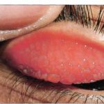 Tracoma : sintomi, cause, complicazioni e cure rp_tracoma1.jpg