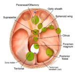 rp_zone-meningioma1.jpg