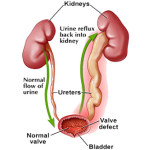 Reflusso vescico-ureterale : sintomi, cause, complicazioni e cure