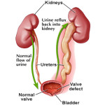 rp_Reflusso-vescico-ureterale1.jpg