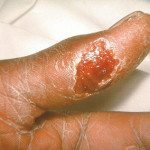 Tularemia : sintomi, cause, diagnosi e cure
