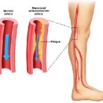 Arteriopatia periferica (PAD) : sintomi, cause, complicazioni e cure