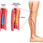 rp_Arteriopatia-periferica-1.jpg