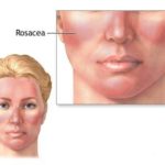 rp_rosacea-e-zone-di-massimo-interesse1.jpg