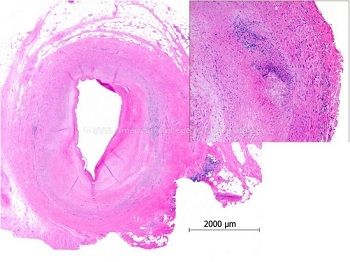 Arterite di Takayasu