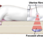 Chirurgia a ultrasuoni focalizzati per i fibromi uterini : procedura, rischi e benefici