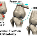 rp_esempio-di-osteotomia-del-ginocchio.jpg