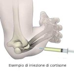 rp_iniezioni-di-cortisone.jpg