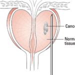 rp_Biopsia-della-prostata.gif