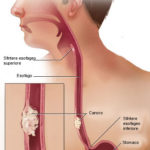 Cancro esofageo : sintomi, cause, diagnosi e cure