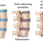 rp_Spondilite-anchilosante.jpg