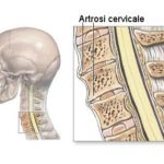 Artrosi cervicale : sintomi, cause, diagnosi e cure