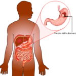 Cancro dello stomaco : sintomi, cause, diagnosi e cure