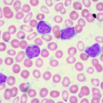Leucemia linfocitica acuta : sintomi, cause, diagnosi e cure