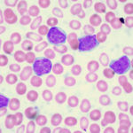 rp_leucemia-linfocitica-acuta.jpg