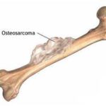 Tumore delle ossa : sintomi, segni, cause, diagnosi e cure