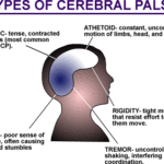 Paralisi cerebrale : cause, sintomi, diagnosi e cure