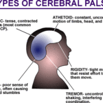 rp_paralisi-cerebrale.gif