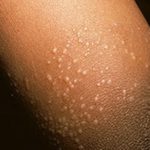 Lichen nitidus : sintomi, cause, diagnosi e trattamenti