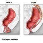 rp_chirurgia-del-prolasso-rettale.jpg