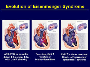 evoluzione della Eisenmenger