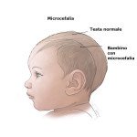 Microcefalia : segni, cause, complicazioni e diagnosi