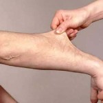 rp_pelle-elastica-nella-sindrome-di-Ehlers-Danlos.jpg
