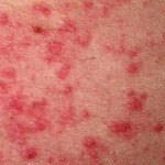 Dermatite atopica (eczema) : cure, cause e sintomi
